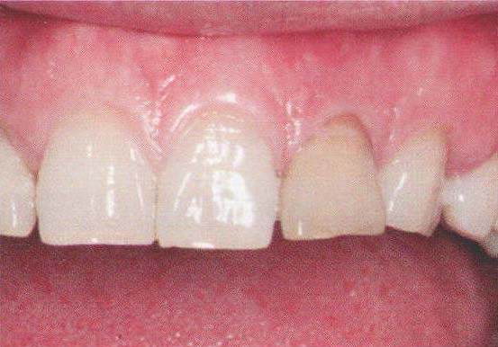 上颌前牙根尖周炎使用Bio-Gide<sup>Ⓡ</sup>+Bio-Oss<sup>Ⓡ</sup>+骨优导<sup>Ⓡ</sup>骨增量后不翻瓣延期种植即刻修复病例报道